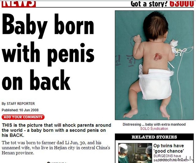 Baby born with penis on back