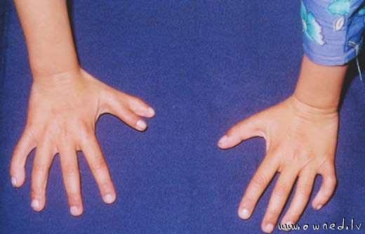 Six fingers